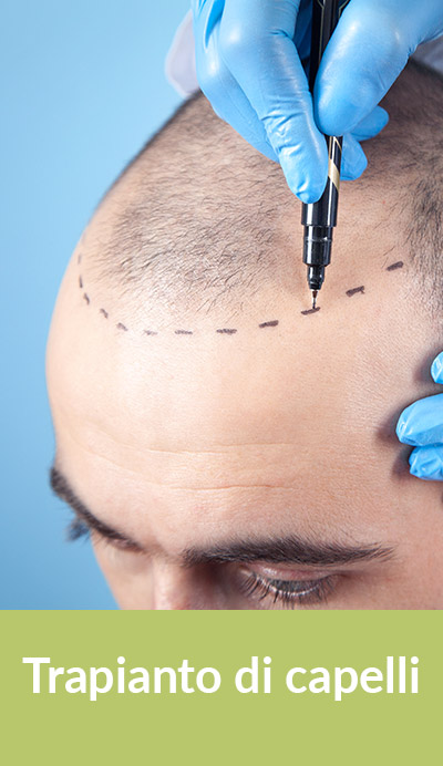 trapianto di capelli